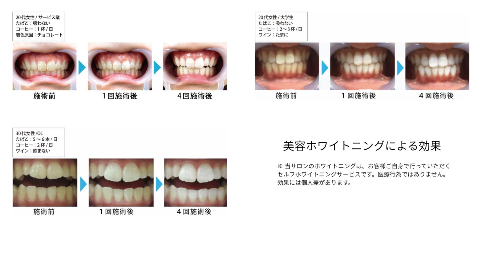 美容ホワイトニングによる効果 症例 ビフォーアフター